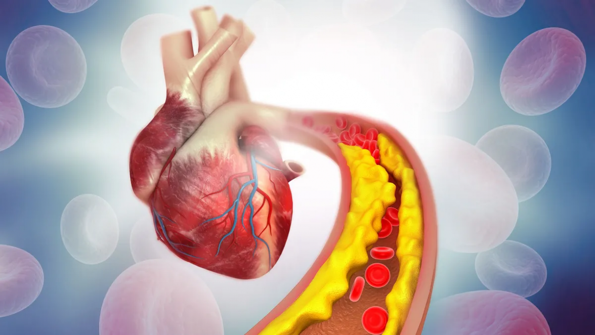 Cholesterinbehandlung im Fokus