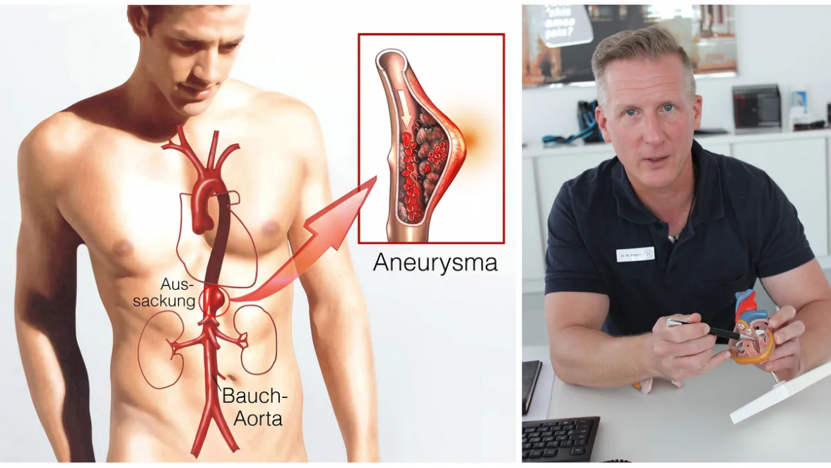 Gefäß-Check: Bauchaorta nicht vergessen!