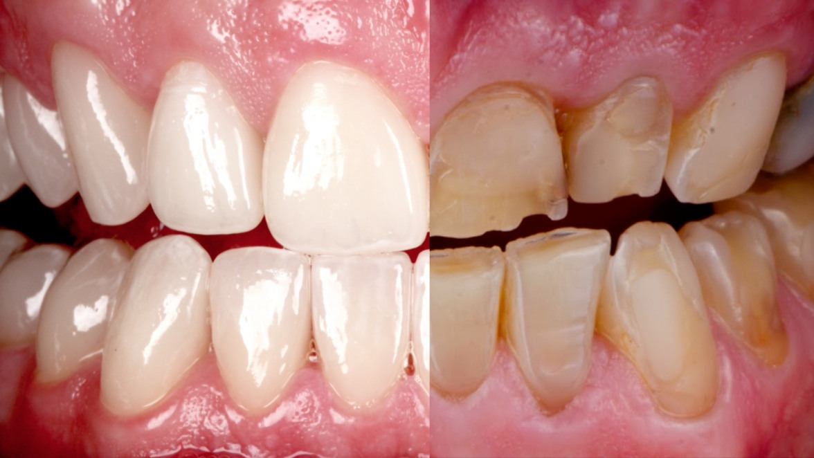 Zahnverschleiß: die neue Volkskrankheit