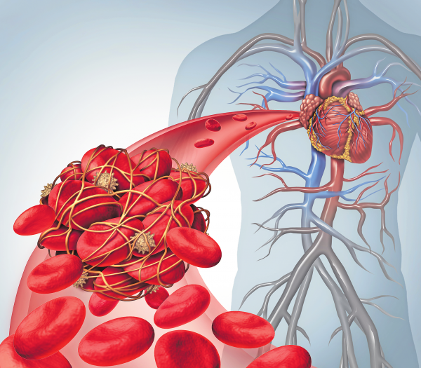 Risikofaktor Thrombose