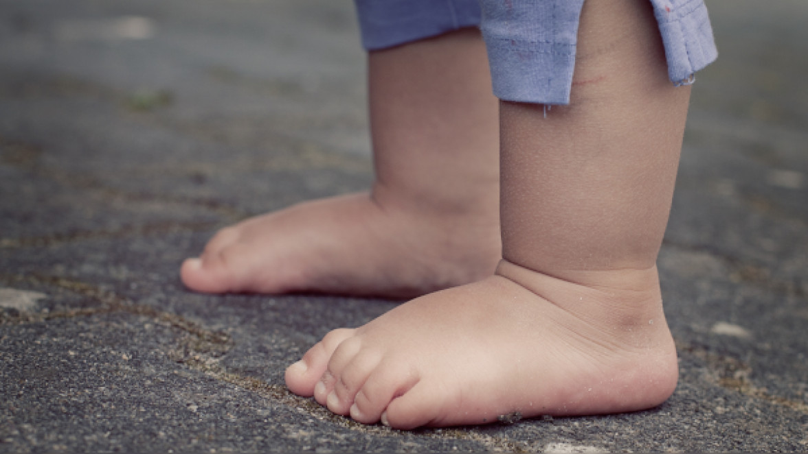Knick-Platt-Füße bei Kindern
