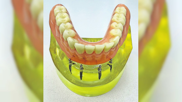 Keine "große Sache“: Mini-Implantate für festen Zahnersatz in wenigen Stunden