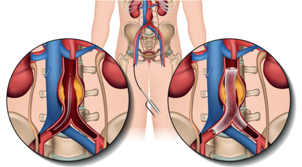 Siloah Forum: Unentdeckt umso gefährlicher - das Aortenaneurysma