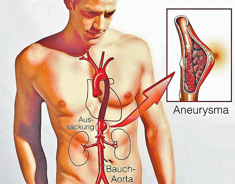 Das Aortenaneurysma – Die unsichtbare Gefahr