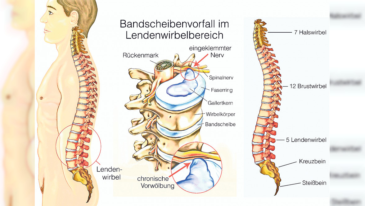 Helios Klinikum Pforzheim: Bandscheiben - wertvolle Puffer