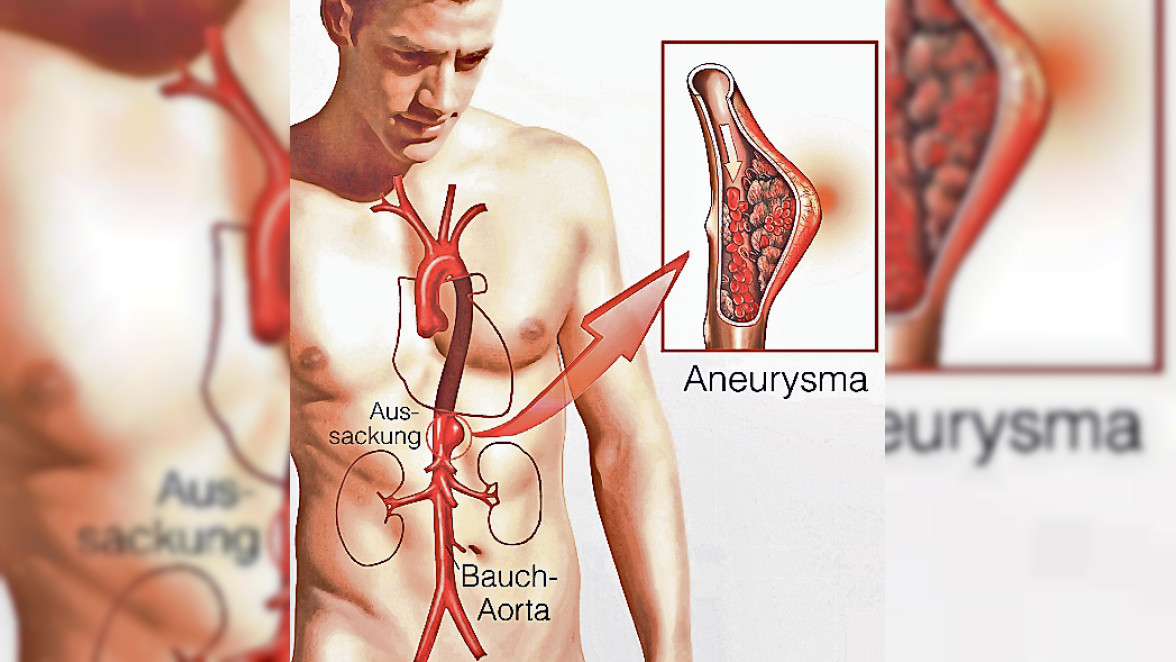Gefahr gebannt, wenn erkannt: Das Aorten-Aneurysma