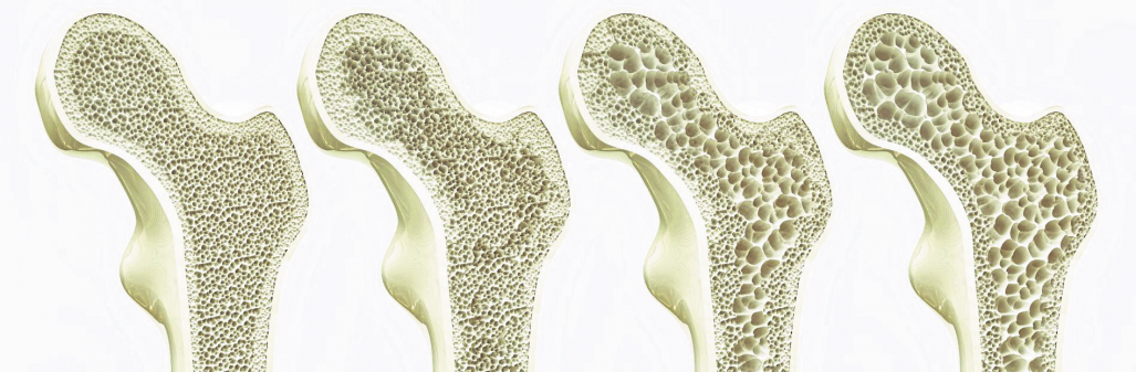 Calcium - wichtiger Therapiebaustein bei Osteoporose