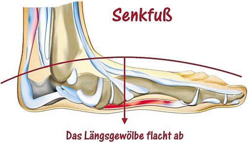 Knick-Senkfuß – Was nun?