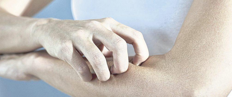 Neurodermitis – neue Therapieansätze lassen hoffen