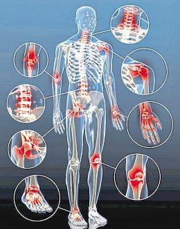Arthrose – Teufelskreis Bewegungsschmerz
