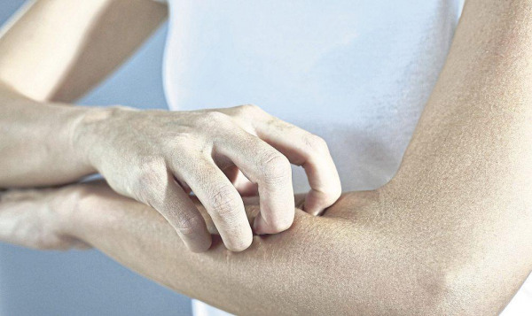 Neurodermitis – neue Therapieansätze lassen hoffen