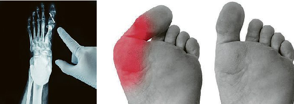 Hallux Valgus - Ursachen und Behandlung