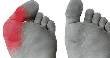 Hallux Valgus - Ursachen und Behandlung