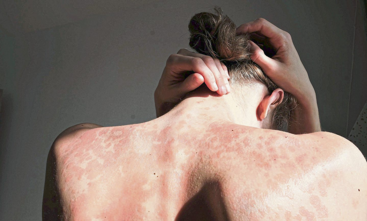 Psoriasis - Nicht heilbar, aber gut behandelbar